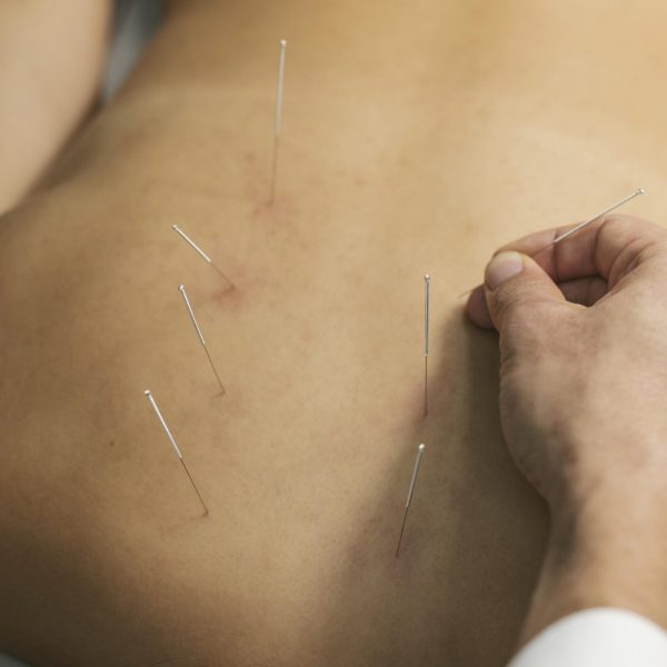 acupuncture-process-close-up