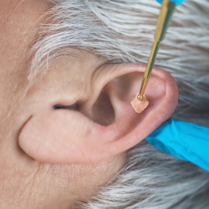 Auricular Therapy