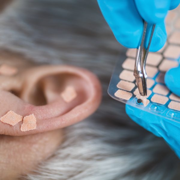 Auriculotherapy, or auricular treatment on human ear, close up. Therapist hand applying acupuncture ear seed sticker with tweezers.